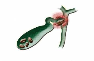 Colecistitis calculosa