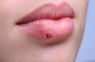 Herpes na perách počas tehotenstva