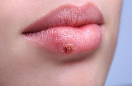 Herpes nos lábios durante a gravidez
