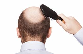 Alopecia androgenética