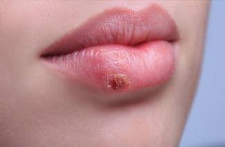 Herpes počas tehotenstva
