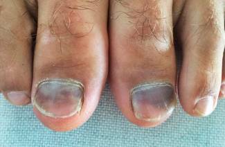 Toenails doer