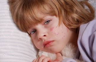 Roseola u detí