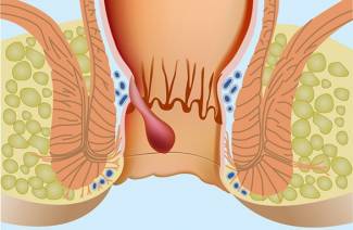 Tratamiento para hemorroides
