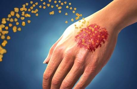 Artritis psoriásica