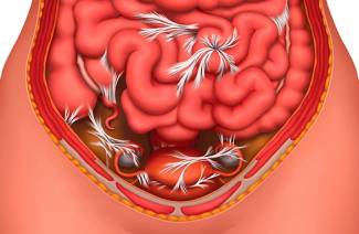 Aderências intestinais após a cirurgia