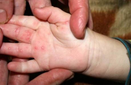 Herpes na paži