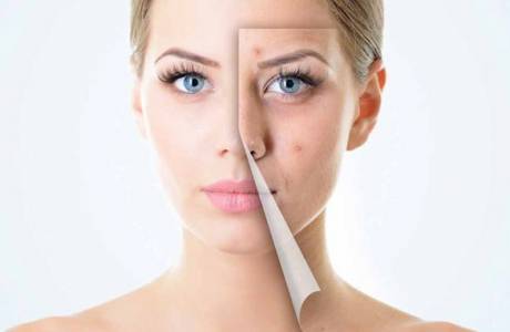 Comprimidos da acne