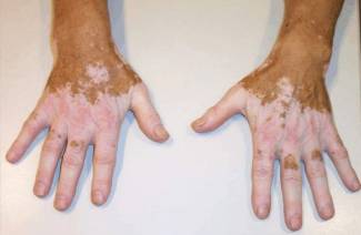 Vitiligoova choroba