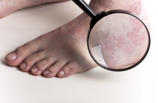 İnsanlarda Microsporia
