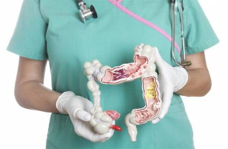 Sintomas de pólipos nos intestinos