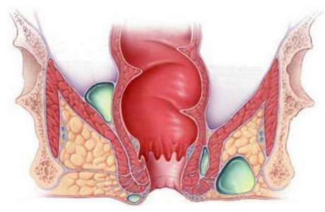 ¿Qué es una fístula?