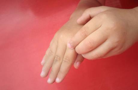 El dyshidrosis tedavisi