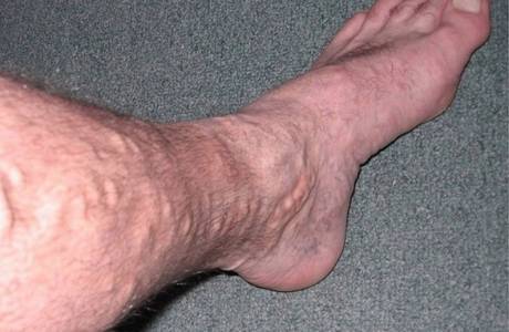 La vena de la pierna duele