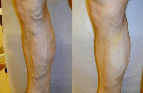 Tratamiento de la aterosclerosis de las extremidades inferiores.