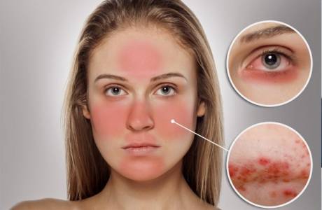 Rosacea na tvári