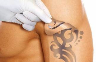 Remoção de tatuagem a laser