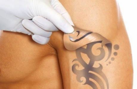 Remoção de tatuagem a laser