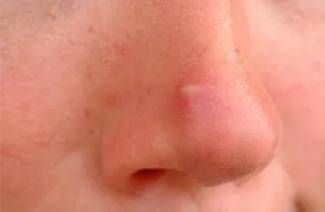 Nachladnutie na nose