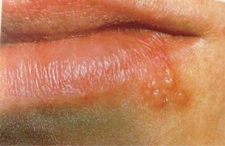 Herpes vírus