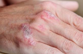 Pustulárna psoriáza