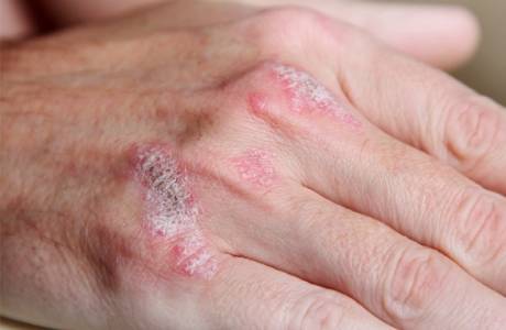 Psoriasis pustulosa