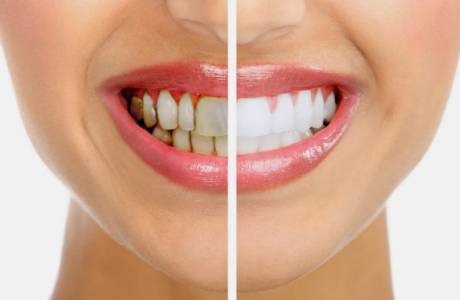 Como tratar remédios populares goma doença periodontal