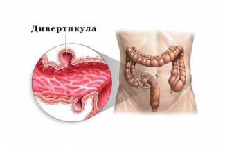 Diverticulose sigmóide