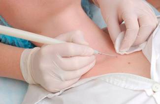 VPH en mujeres