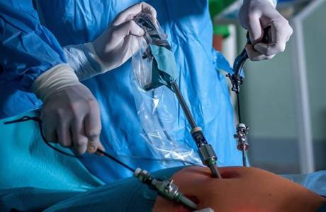 Laparoskopia v gynekológii