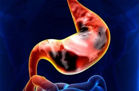 Cáncer de estómago