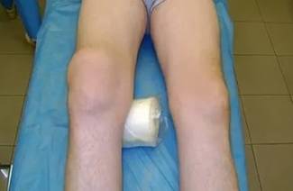 Deformujúca osteoartróza kolena