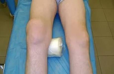 Osteoartrose deformante do joelho