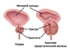 Лечење аденома простате