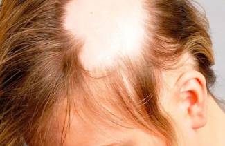 Alopecia areata