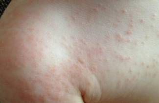Herpes tipo 6