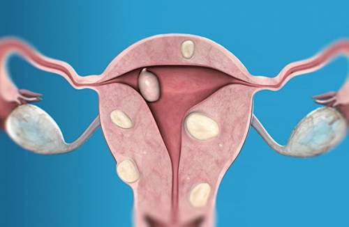Miomas uterinos submucosos
