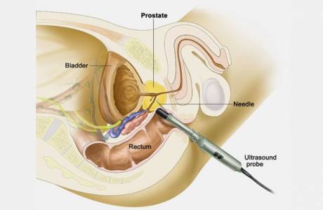 Biopsia prostaty