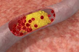 Jak czyścić naczynia cholesterolowe środkami ludowymi
