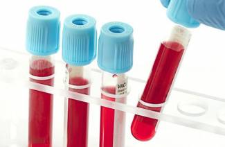 Causas del aumento de la creatinina en sangre