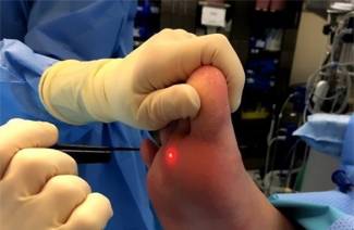 Remoção de verruga plantar a laser