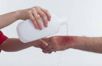Qué hacer con una quemadura de agua hirviendo