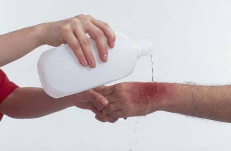 O que fazer com uma queimadura de água fervente