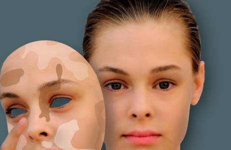 ¿Qué es el vitiligo?