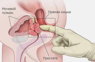 Výhody a poškodzuje masáž prostaty