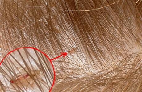 Pediculosis u dzieci