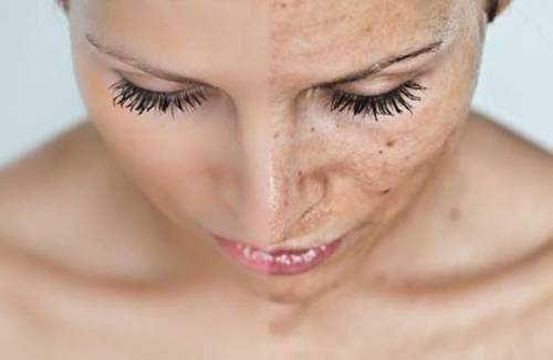 Creme para manchas da idade