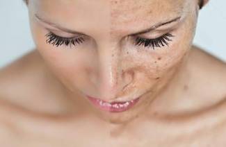 Creme para manchas da idade