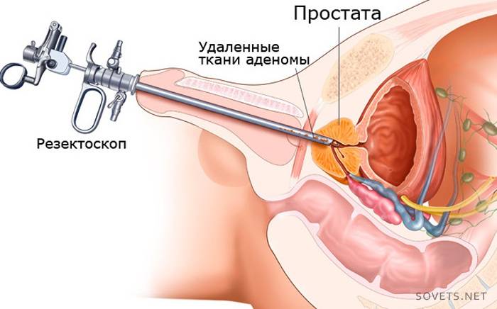 Minimálne invazívne metódy liečby adenómu prostaty