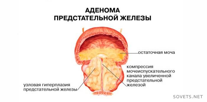 adenóm prostaty